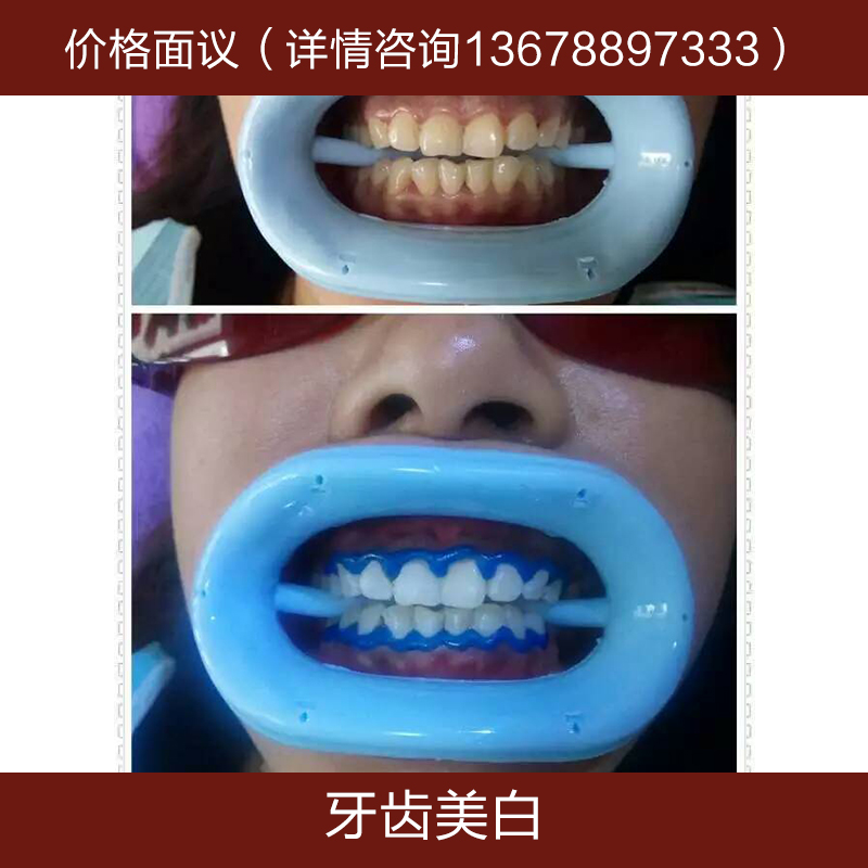 供应牙齿美白 冷光美白牙齿 蓝光美白 炫齿美白加盟培训课程图片